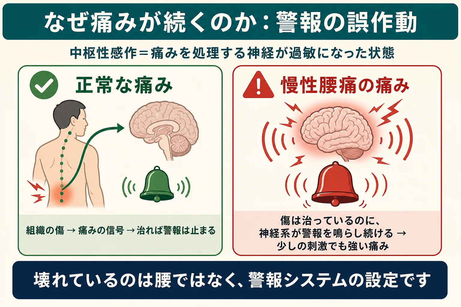 中枢性感作の図解：正常な痛みは治れば警報が止まるが、慢性腰痛では傷が治っても神経系が警報を鳴らし続ける